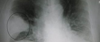 Сгусток - признак правосторонней пневмонии