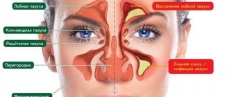 Схема отличия гайморита от здорового носа