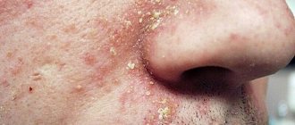 Сикозиформная экзема на лице