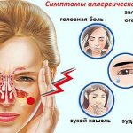 Симптомы ринита