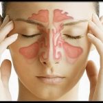 Синусит - причина головных болей в переносице