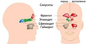 Типы воспалительных реакций в носовых пазухах