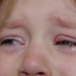 У девочки припухший глаз