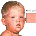 у ребенка сыпь кашель насморк