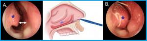 Ультразвуковая дезинтеграция нижних носовых раковин