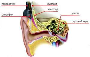 Установка слухового импланта при тугоухости