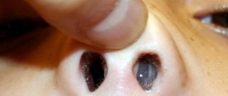 вид полипов в носу у ребенка