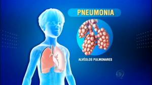 Вирусная пневмония у детей симптомы
