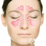 Воспаление гайморовых пазух серозного характера называется катаральным гайморитом