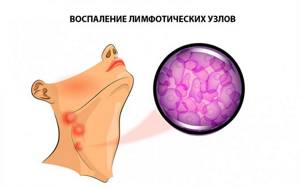Воспаление лимфоузлов при ангине, тонзиллите