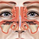 Воспаление слизистой нескольких пазух носа