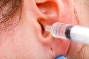 Вымывание из уха серной пробки в кабинете врача