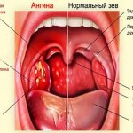 Здоровое и больное горло